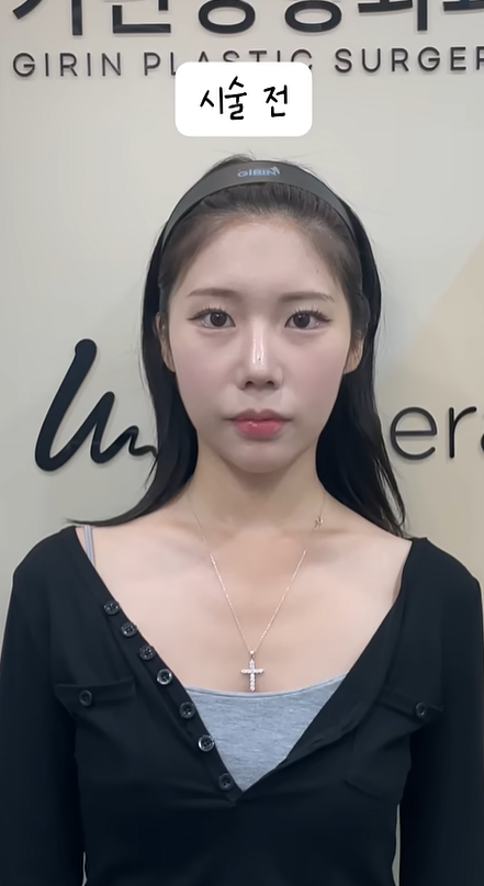 기린성형외과 인중리프팅 + 귀필러 관련 이미지 2