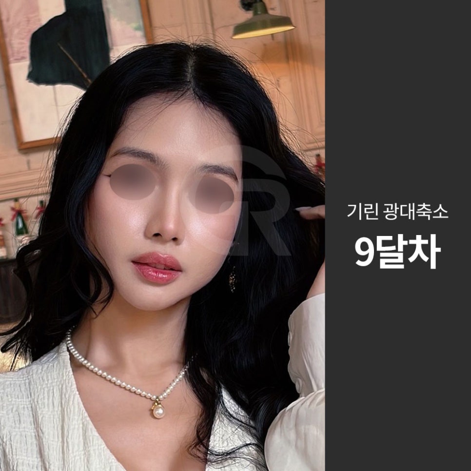 광대가 큰 얼굴, 축소술은 인상을 조율하는 기준점입니다 관련 이미지 8