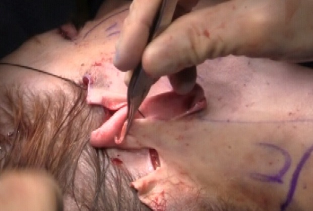 [공유] 안면거상술 고민중이시라면 꼭 읽어보세요! 다른 시술이 아닌 안면거상술을 선택해야 하는 해부학적 근거 관련 이미지 8