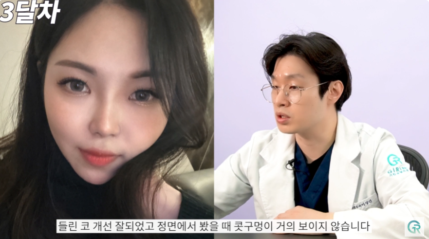 [기린성형외과] 짧고, 들린 코 탈출!_코성형 수술일지 관련 이미지 10