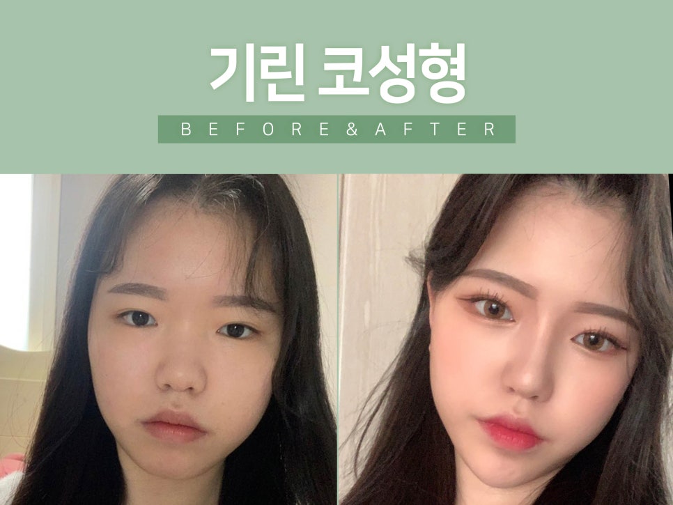 낮은코수술 원하는 라인으로 관련 이미지 6