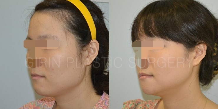 긴곡선브이라인 16일째 경과 관련 이미지 2