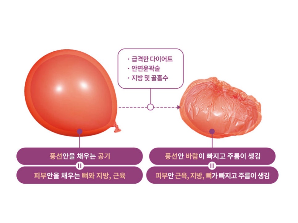 안면거상수술 효과 확실하려면 관련 이미지 3