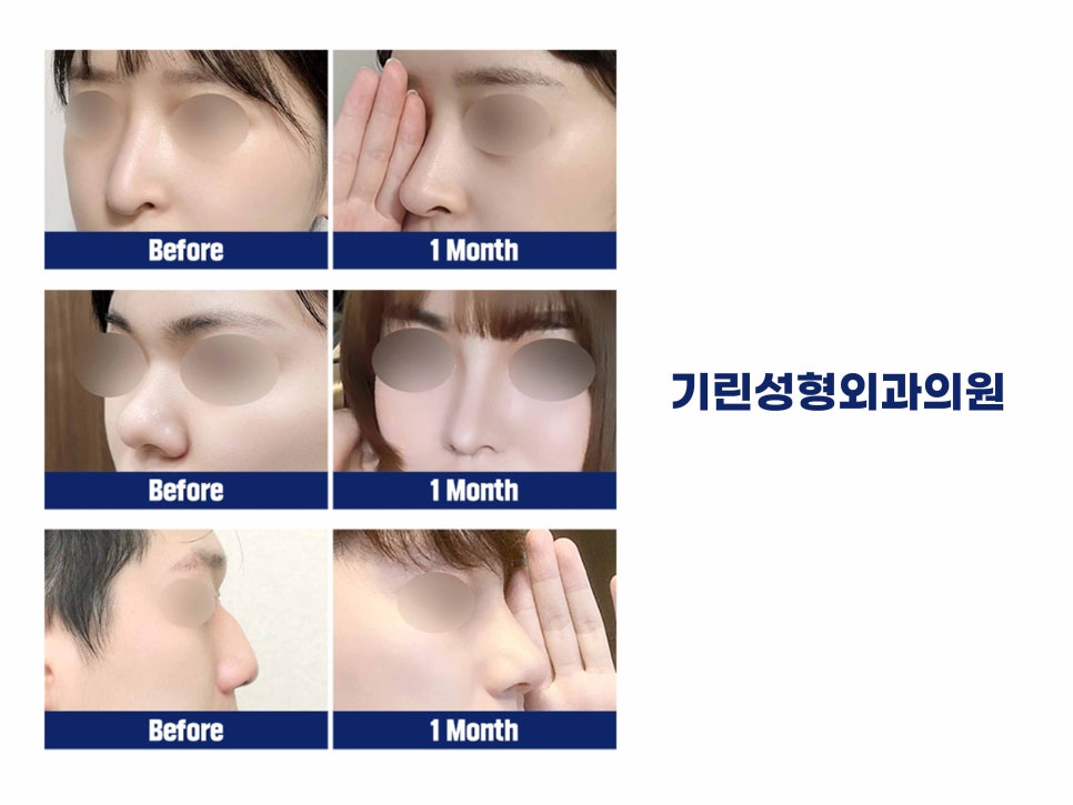 강남역성형외과유명한곳 얼굴에 맞춰 조화롭게 관련 이미지 16