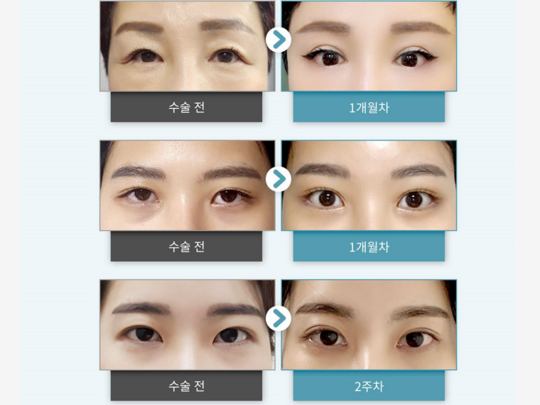 내시경이마거상 탄력 고민을 해결하는 관련 이미지 1