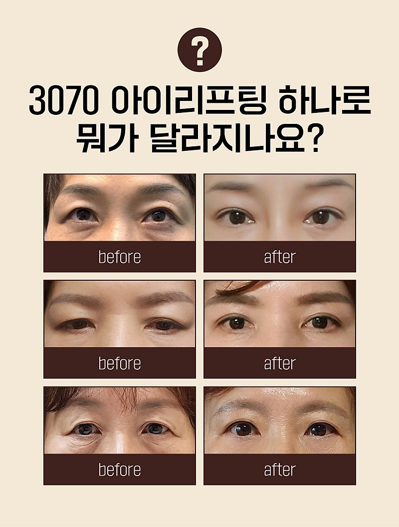 이마눈썹거상술 눈처짐 자연스럽게 눈가 리프팅 효과처럼! 관련 이미지 4
