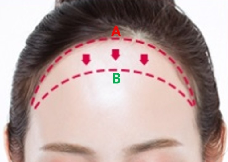 [공유] 이마축소술! 어떤 과정으로 수술하는지 알려드립니다 (안심하세요!) <<수술과정 大해부>> 관련 이미지 6