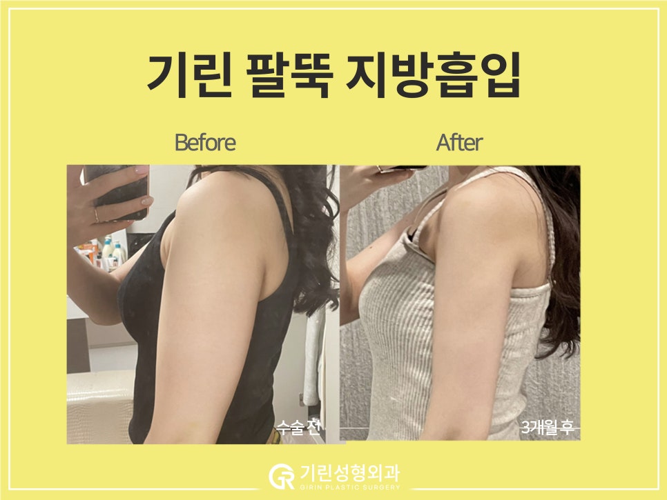 [기린 성형외과] 예쁜 라인 찾는 체형별 팔뚝지방흡입 관련 이미지 2