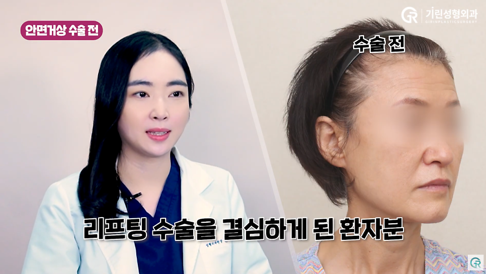 [기린성형외과의원] 부모님들 사이에서 유행하는 성형_안면거상 수술일지 관련 이미지 4