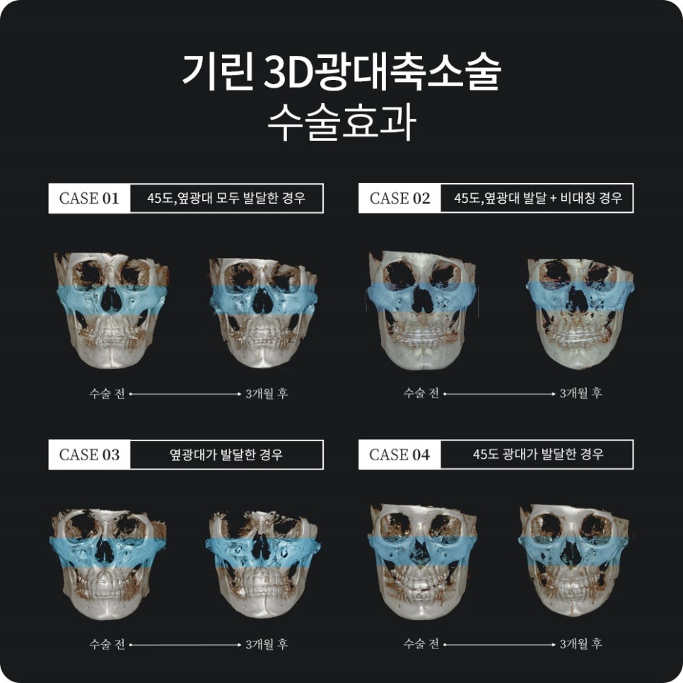 안면윤곽후기? 사실 도움 안 되는 이유 관련 이미지 9