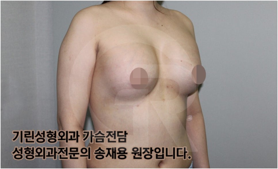 가슴확대수술 후 관리방법, 실제사례 알아보다. [기린성형외과의원_Dr.송재용] 관련 이미지 9