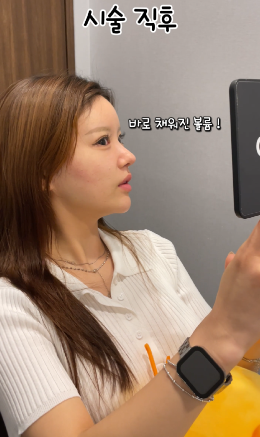 기린성형외과 쥬베룩볼륨 팔자주름, 앞볼, 관자 후기 관련 이미지 8