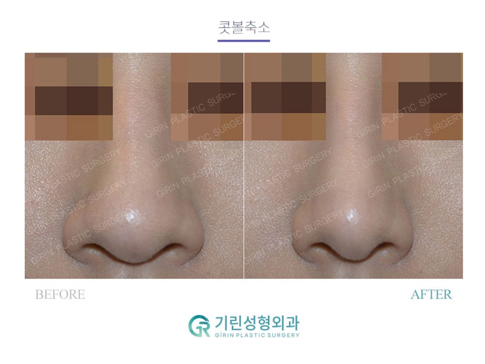 복코수술후기 제대로 찾아야 하는 이유는 관련 이미지 9