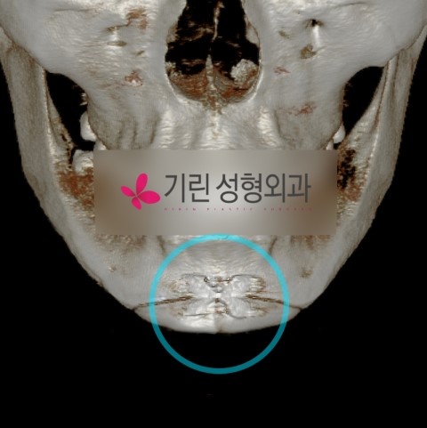 사각턱후 생길 수 있는 부작용 관련 이미지 2