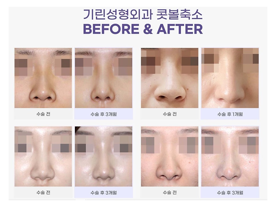 서울코수술 생김새에 따라 다르게 관련 이미지 9