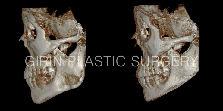 긴곡선브이라인 16일째 경과 관련 이미지 6