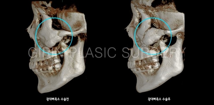 45도광대, 옆광대축소수술 전후 3DCT비교 관련 이미지 3