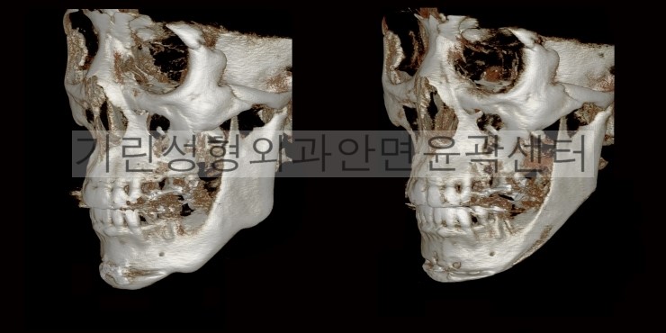 [이차각재수술사례] 긴곡선절제술을 통한 이차각제거, V라인수술 관련 이미지 2