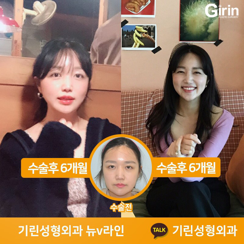 [뉴브이라인]45도 라운딩 브이라인 절골술로 작은 얼굴 만들기 관련 이미지 6