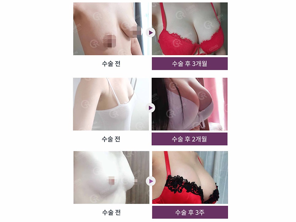 멘토가슴성형 다른 점이 무엇일까? 관련 이미지 15