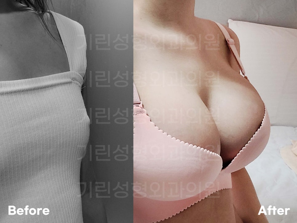 멘토가슴성형 차이를 알고 선택해야 관련 이미지 10