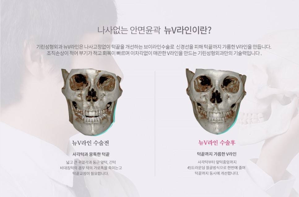 [뉴브이라인]45도 라운딩 브이라인 절골술로 작은 얼굴 만들기 관련 이미지 4