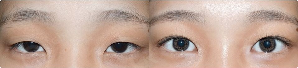 쌍수가격? 의미 없는 이유 관련 이미지 1