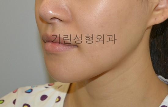 안면윤곽 후 재수술사례 : 부작용으로 인한 재수술 관련 이미지 1