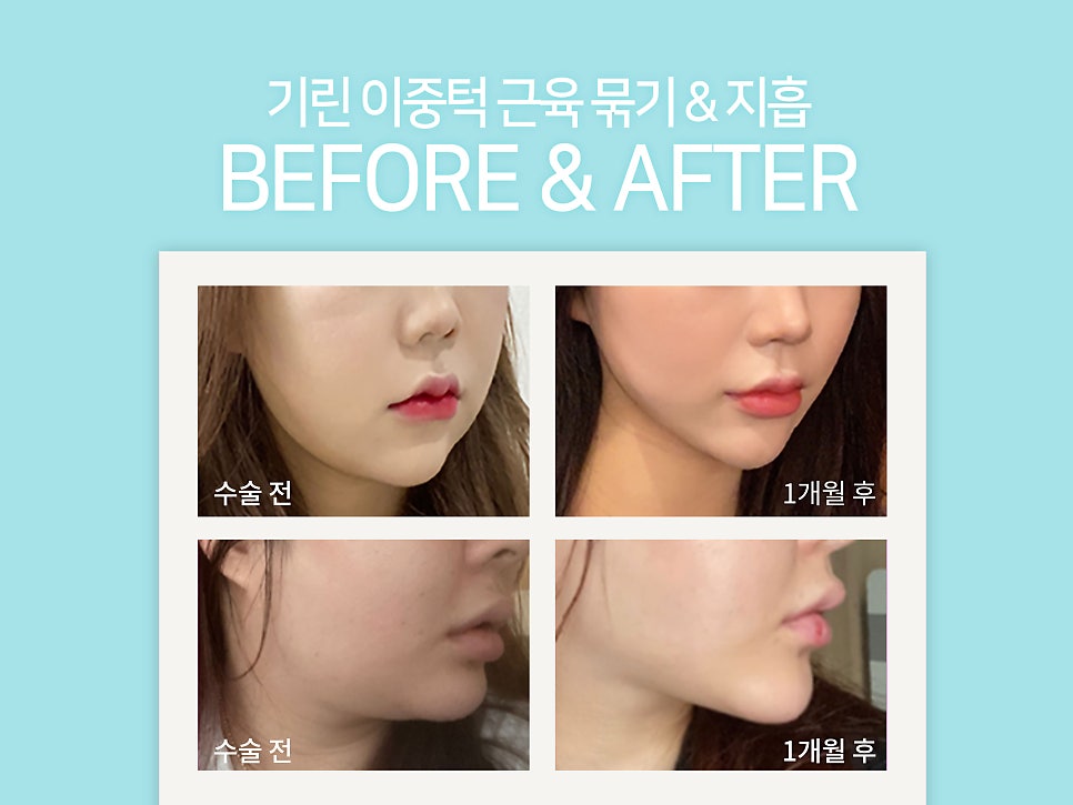 이중턱지방흡입 고려하고 있다면 관련 이미지 6