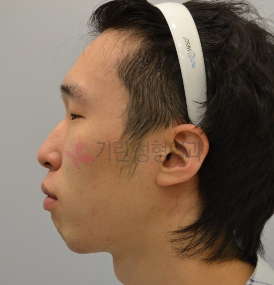 돌출입을 코성형으로 교정한다? [돌출입수술 솔루션 01] 관련 이미지 1