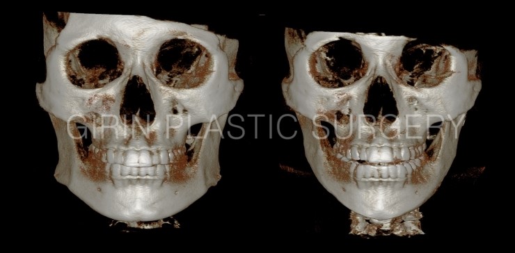 볼살과 턱이 발달한 케이스 관련 이미지 1