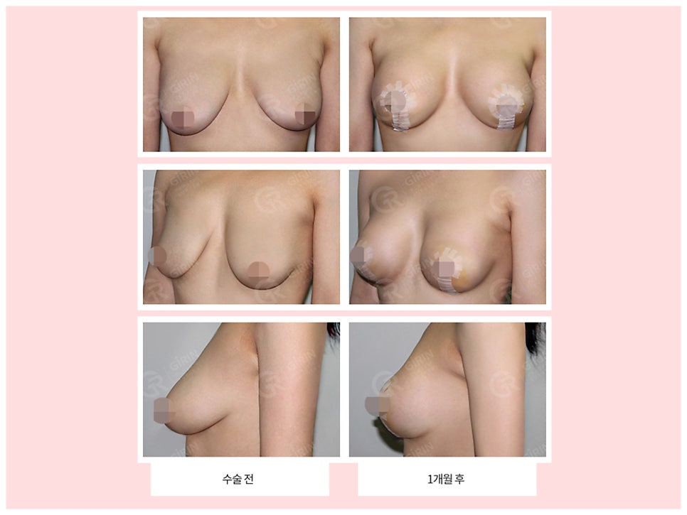 출산후 가슴수술 필요하다 느낀다면 관련 이미지 8
