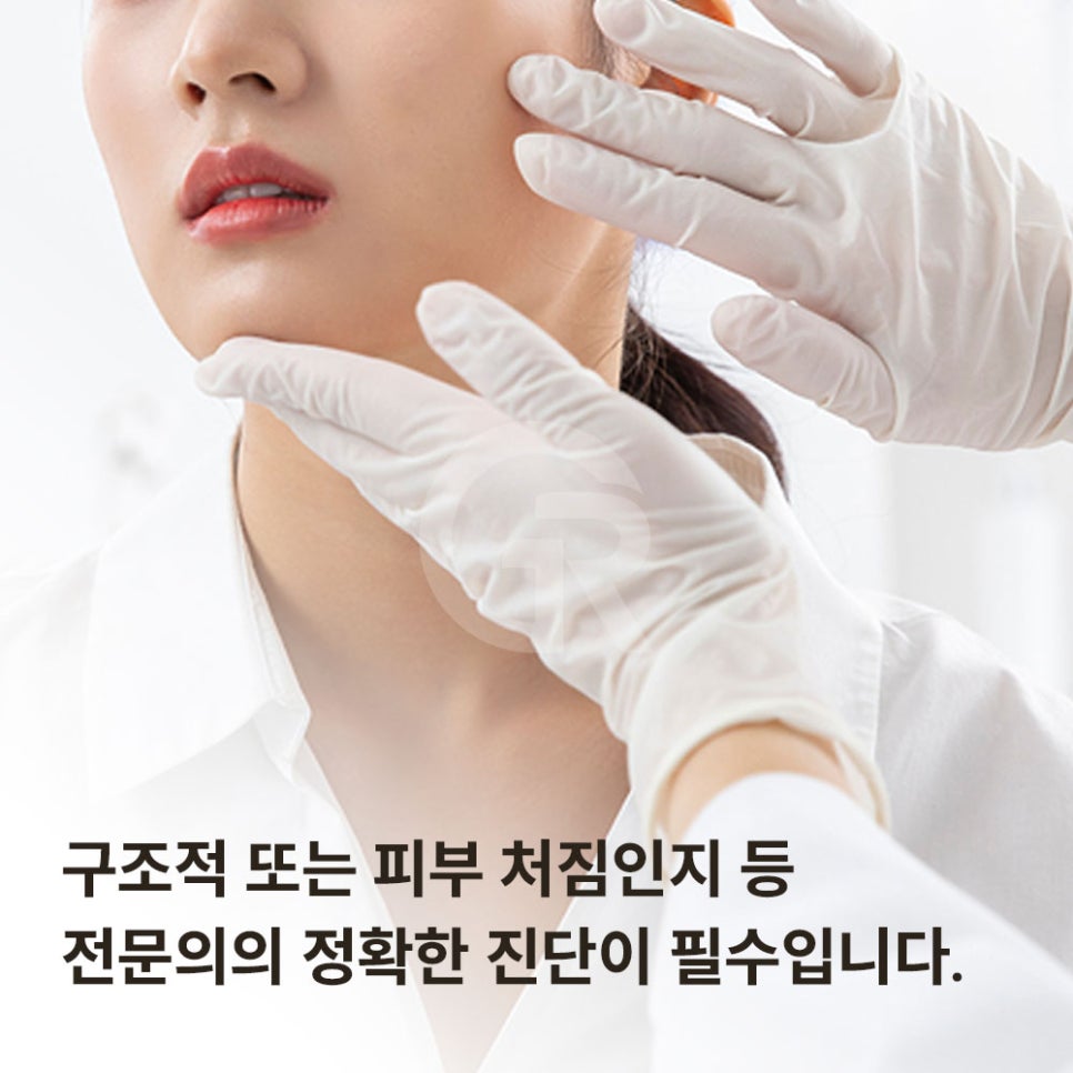 깊은 팔자주름 때문에 미니거상을 진행한 케이스(+코재수술) 관련 이미지 2