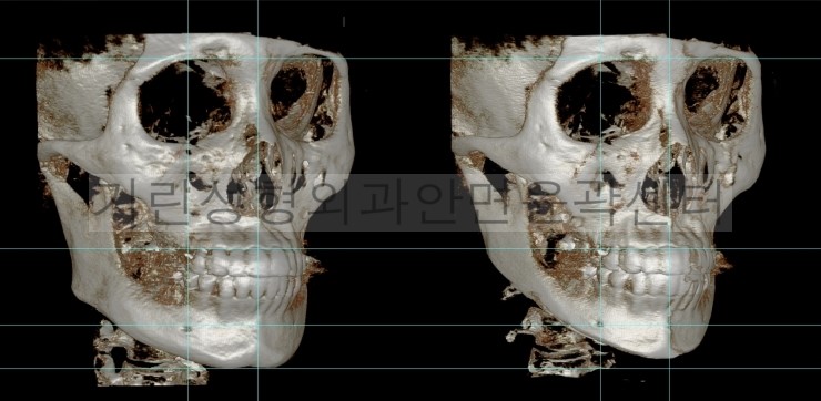 넓은턱수술+아큐스컬프+귀족 1달차 관련 이미지 4
