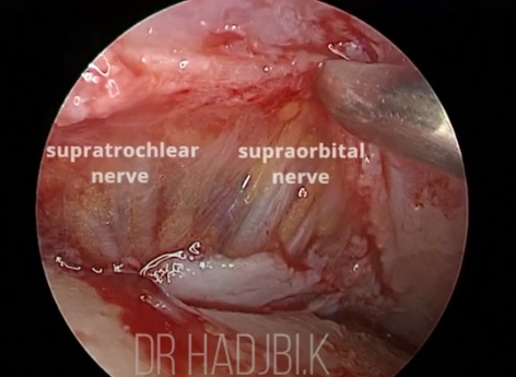 [공유] "이마거상술" 실제 수술은 어떻게 진행되나요? 관련 이미지 5