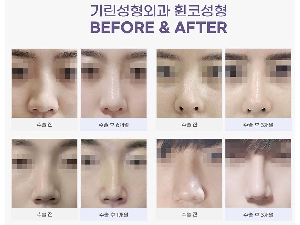 서울코수술 생김새에 따라 다르게 관련 이미지 7