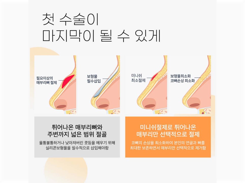 매부리코수술후기 올바른 라인으로 관련 이미지 8