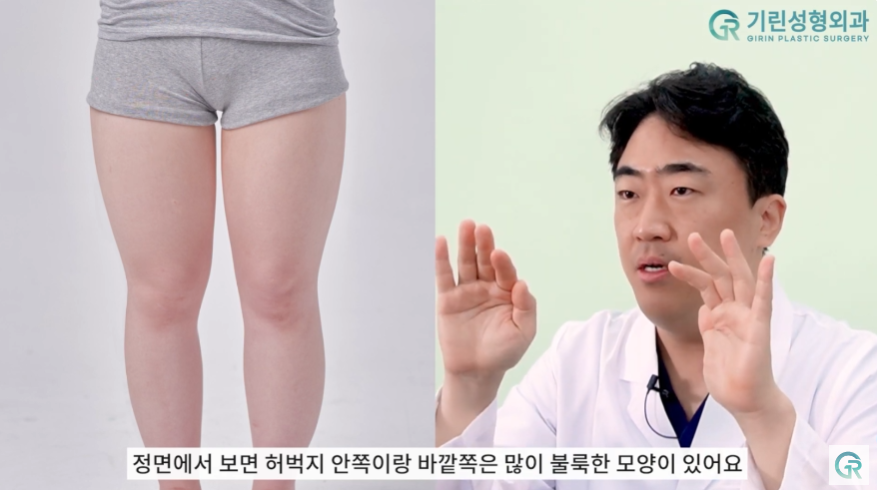 [기린성형외과의원] 뼈벅지?허틈!_허벅지지방흡입 수술일지 관련 이미지 6
