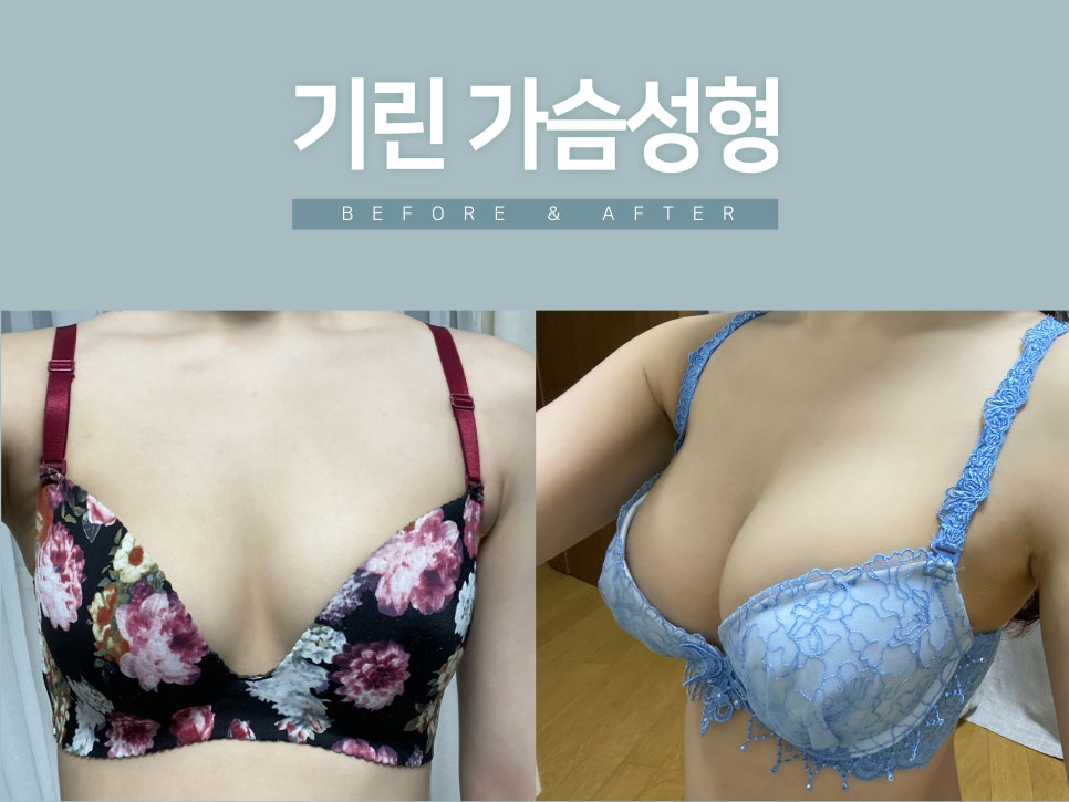 가슴성형 촉감도 중요하니까 관련 이미지 2