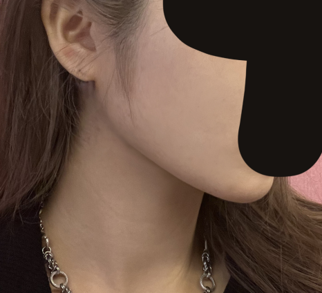 연조직윤곽술 후기, 볼살보다 신경 쓰였던 턱선 변화 관련 이미지 7