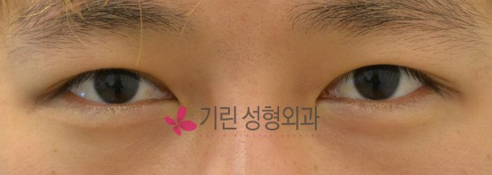 남자 쌍꺼풀수술 자연스럽게 ★ 관련 이미지 2