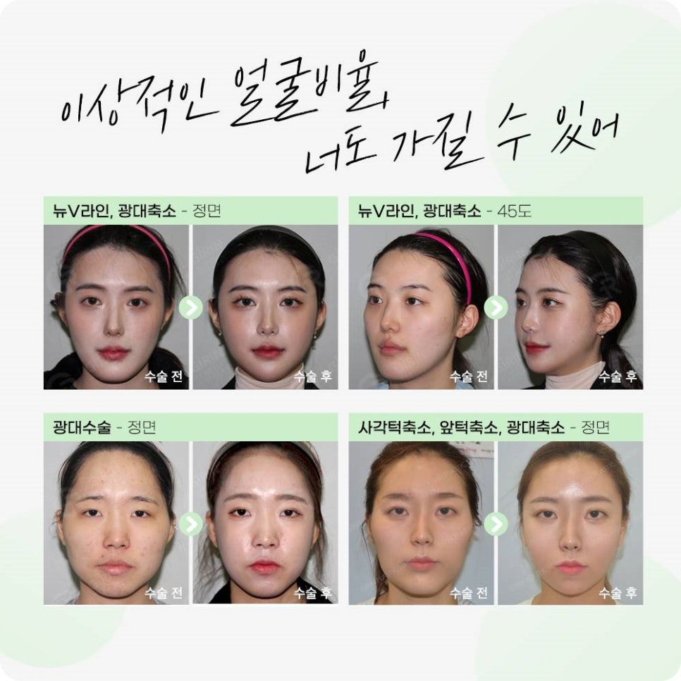 안면윤곽후기? 사실 도움 안 되는 이유 관련 이미지 14