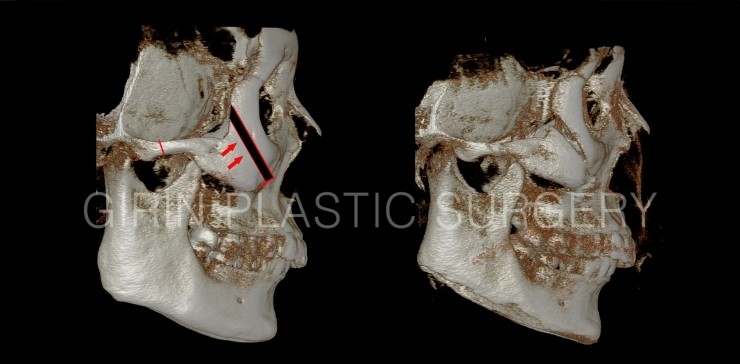 광대축소 불유합과 L절골에 대해 관련 이미지 6