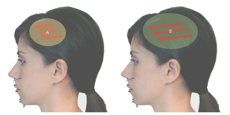 [공유] 이마축소술 두피탄력도 측정? 정말 그렇게 하는게 맞아요? 저는 몇 센티를 줄일 수 있나요? 관련 이미지 3