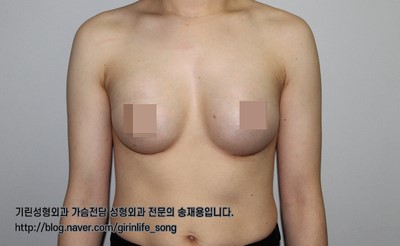 [가슴확대성형] 75A에서 75C로, 모티바 보형물을 이용한 가슴 확대 수술 케이스 관련 이미지 8