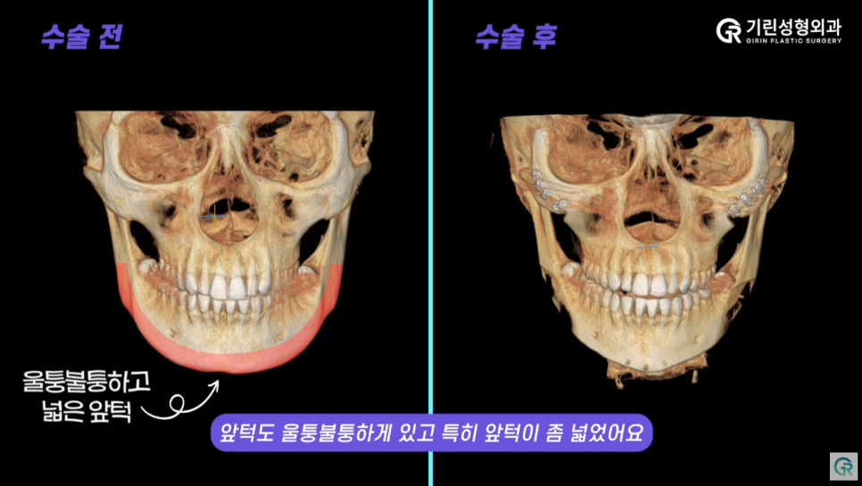[기린성형외과의원] ❌보정어플은 당장 삭제❌_윤곽3종 수술일지 관련 이미지 8