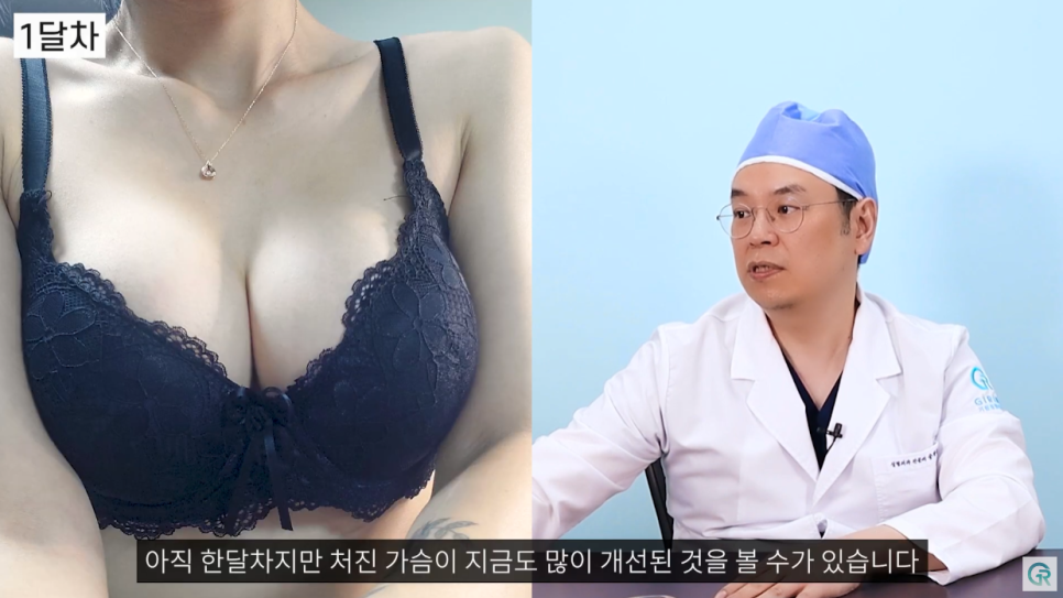 [기린성형외과의원] 다이어트 후 작고, 처진가슴 개선방법_가슴성형 수술일지 관련 이미지 7