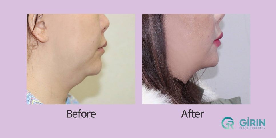 강남이중턱지방흡입 체크할 것 관련 이미지 9