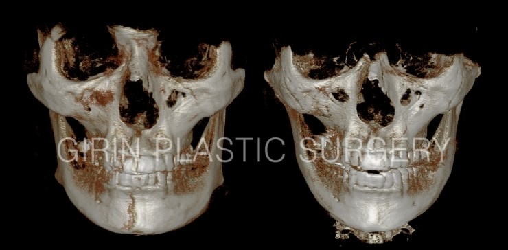 긴곡선(넓은턱), 무고정광대 전후CT 관련 이미지 1
