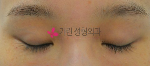 비절개눈매교정 흉터[수술후 3개월경과] 관련 이미지 1